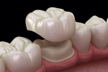 Dental Crowns Plano