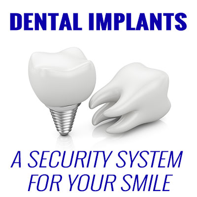 Dental Implants – A Security System for Your Smile