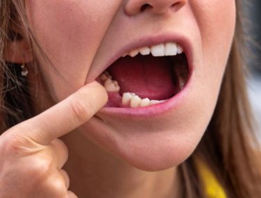 Missing Teeth? Fixed Bridges Restore Your Smile!