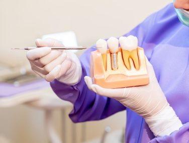 What to Expect During the Healing Process After Dental Implants