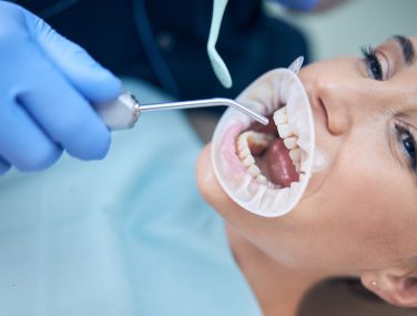 Beyond Strips: How Dentists Get Your Teeth So White