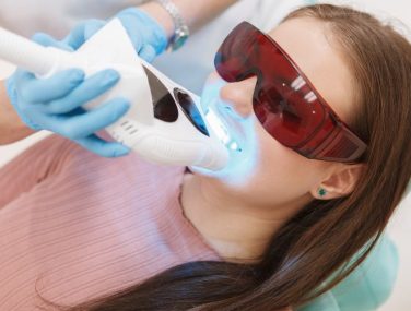 Why Professional Teeth Whitening Beats At-Home Treatments