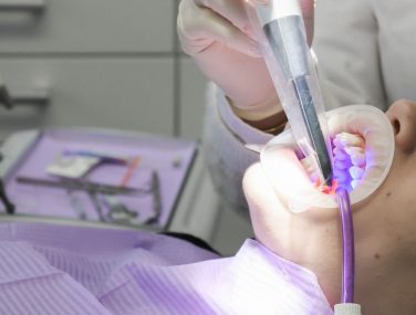 5 Factors That Affect the Lifespan of a Dental Bridge