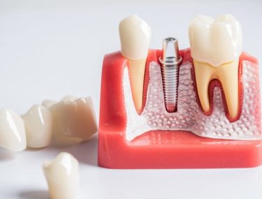 How Long Do Crowns Last on Teeth? Everything Patients Should Know