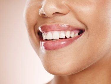 Is Tooth Bonding a Good Option? Everything You Need to Know