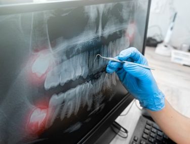 Can Oral Cancer Screenings Detect Other Dental Issues?