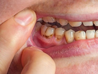 How to Identify a Severe Cavity Before It’s Too Late