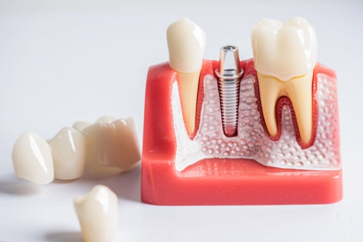How Long Do Crowns Last on Teeth? Everything Patients Should Know